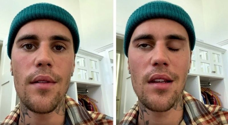 Justin Bieber revela que tiene el síndrome de Ramsay Hunt