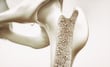 Osteoporosis, enfermedad silenciosa que causa 70% de las fracturas   