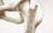Osteoporosis, enfermedad silenciosa que causa 70% de las fracturas   