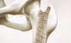 Osteoporosis, enfermedad silenciosa que causa 70% de las fracturas   