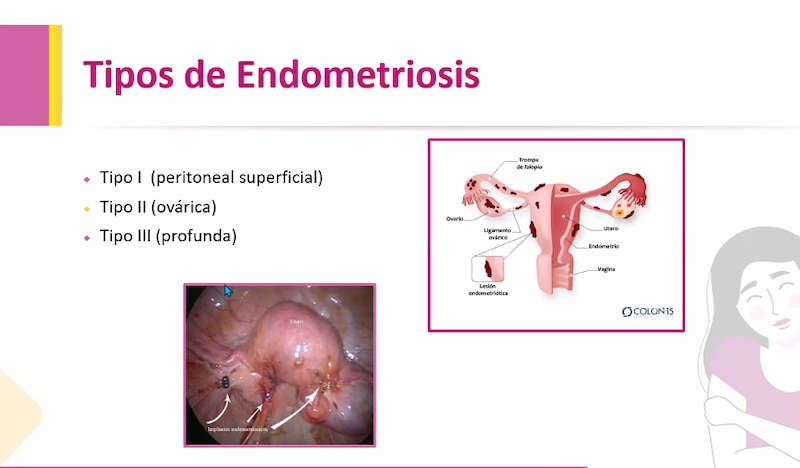 Tipos de endometriosis