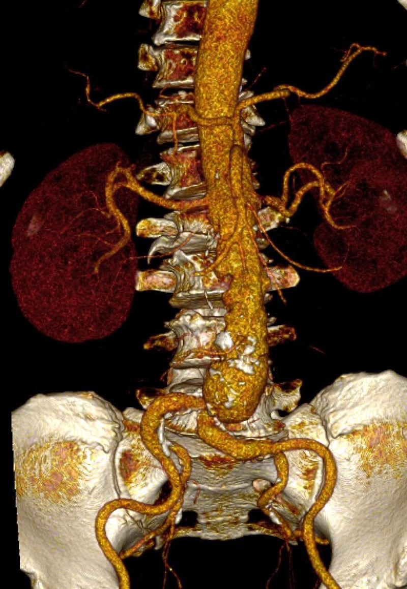 La endoprótesis aórtica es un dispositivo en forma de tubo, con una malla metálica que se implanta en la aorta por una pequeña punción en la ingle con una guía y un catéter, sin tener que someter al paciente a una cirugía abierta
