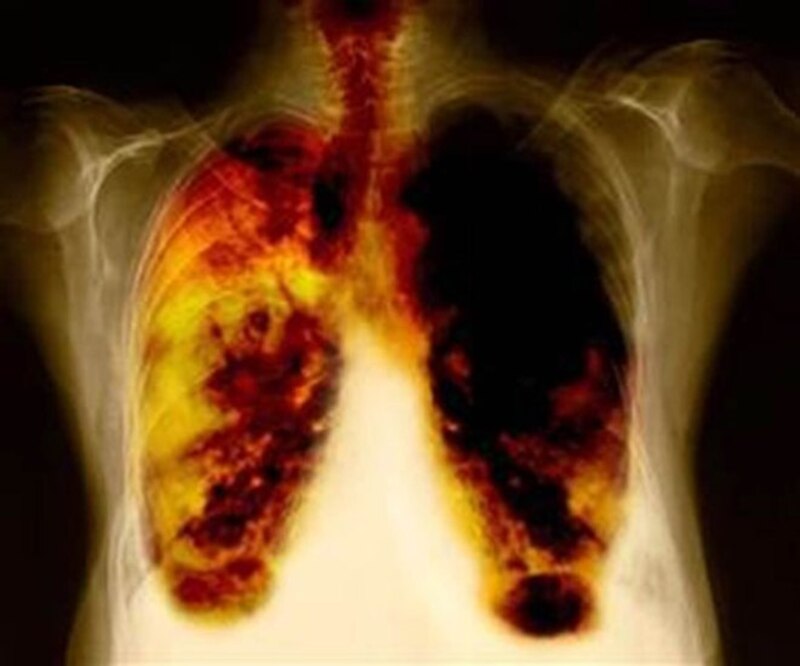 Radiografía de pulmones con cáncer