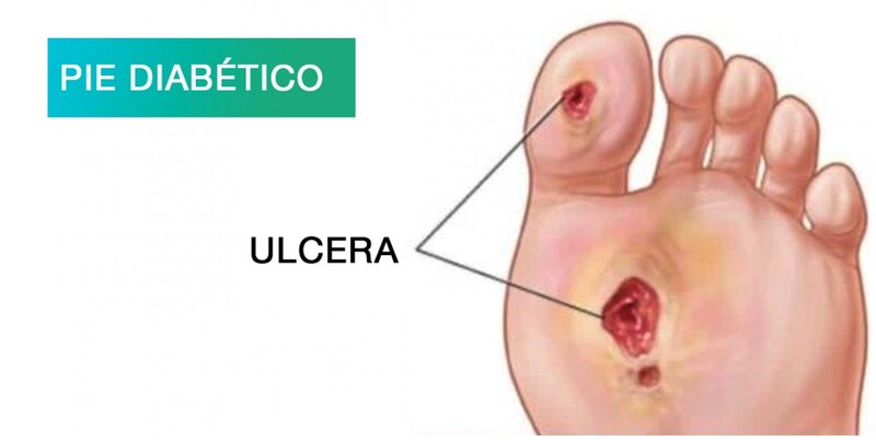 Úlceras en el pie diabético