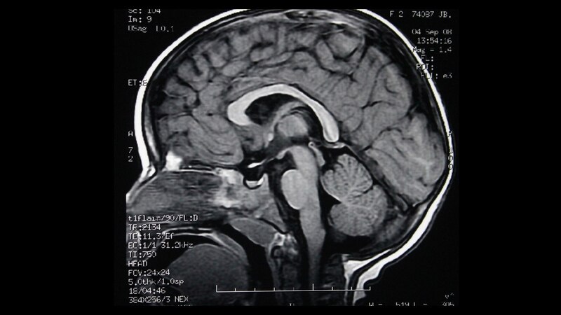 Resonancia magnética del cerebro