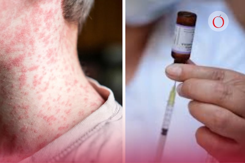 ¿Qué significa que un país no esté libre de sarampión y cuáles ya no están en esa categoría?