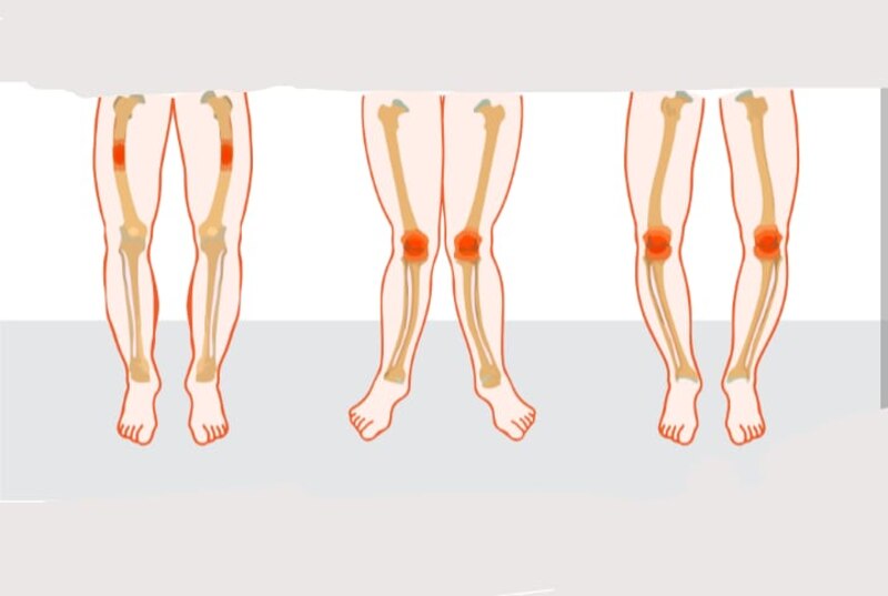 Diferentes tipos de piernas y sus problemas