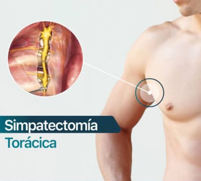 Simpatectomía torácica