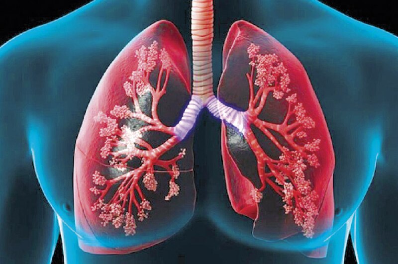 Pulmones