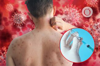 Brote de sarampión en México: ¿Dónde te puedes vacunar en CDMX gratis?