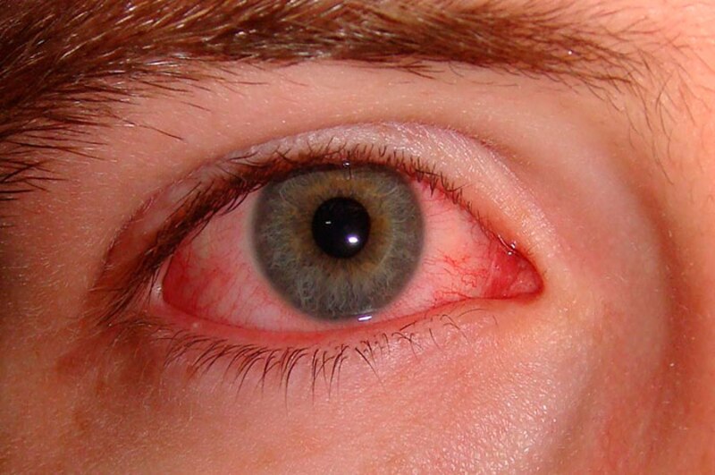 Ojo rojo