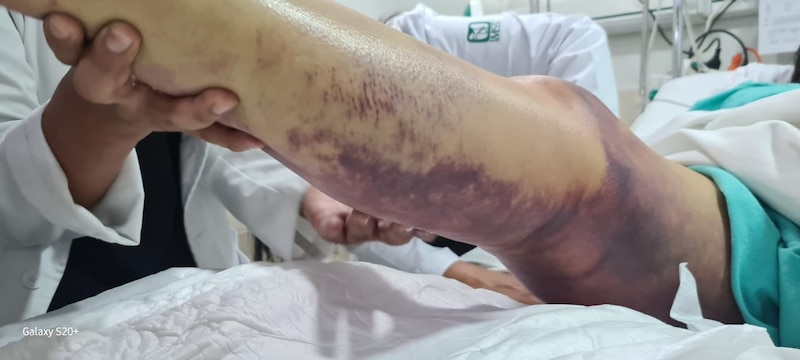 La joven Adriana, sufrió una mordedura de víbora, y logró sobrevivir, gracias a la atención recibido en la Unidad Médica de Alta Especialidad (UMAE), "Dr. Gaudencio González", en La Raza