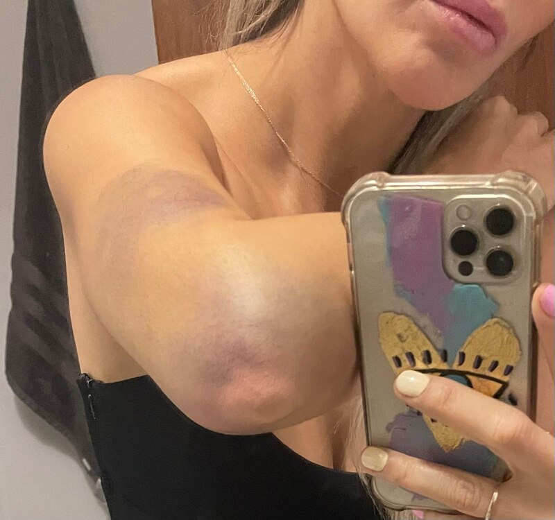Mujer muestra moretón en el brazo