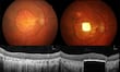 Una prótesis ocular permite leer a personas con ceguera irreversible