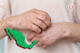Sarampión en México: ¿Cuáles son los estados con más casos?