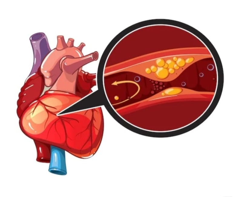 Aterosclerosis