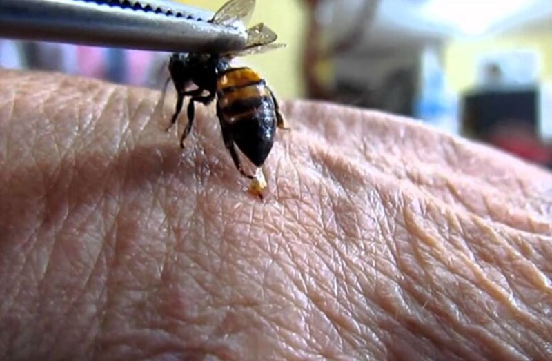 Abeja picando la mano de una persona