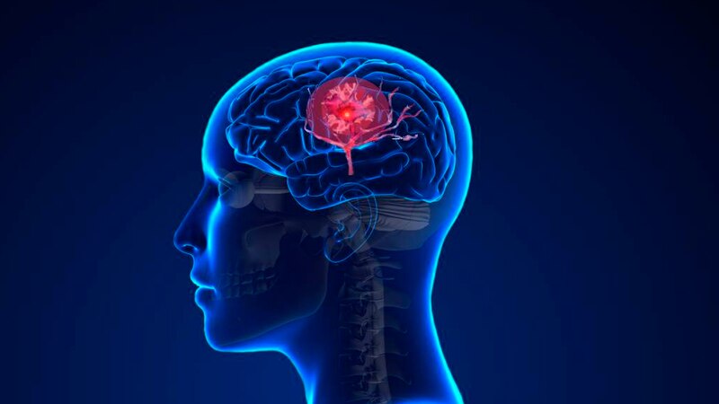Accidente cerebrovascular