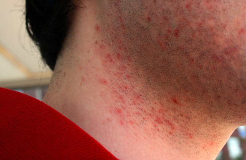 Cómo prevenir la foliculitis