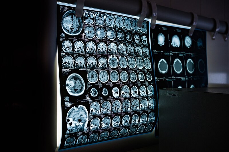 Resonancia magnética del cerebro