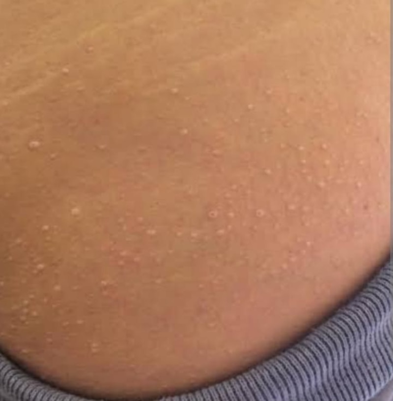 ¿Qué son estas pequeñas bolitas blancas en mi piel?