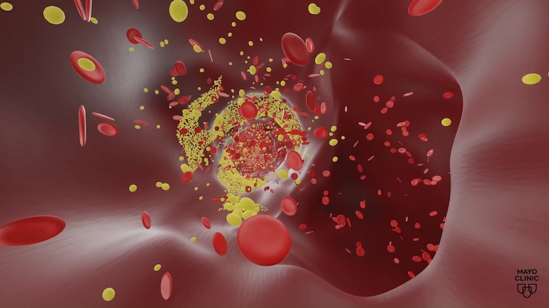 Hay factores de riesgo como: hipertensión, diabetes, sobrepeso o tabaquismo que son modificables y puede reducir el riesgo de demensia vascular