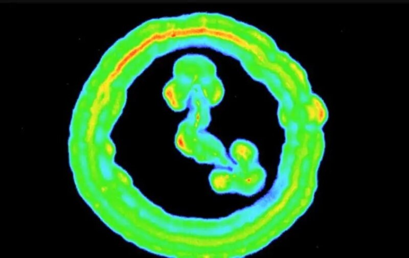 Resonancia magnética de un tumor cerebral