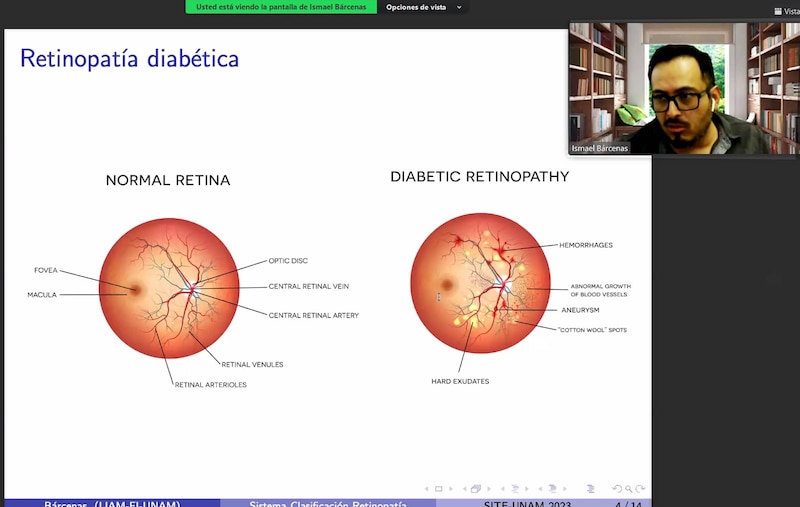 Retinopatía diabética