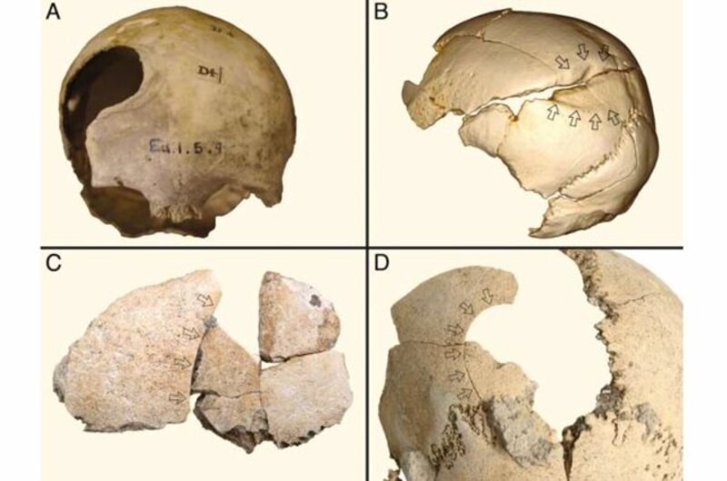 Cráneo humano con fracturas