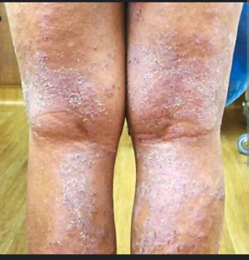 Piernas con psoriasis