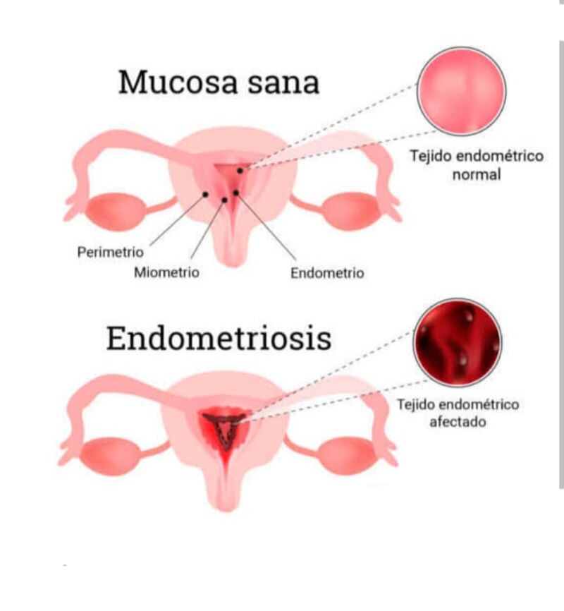 Endometriosis