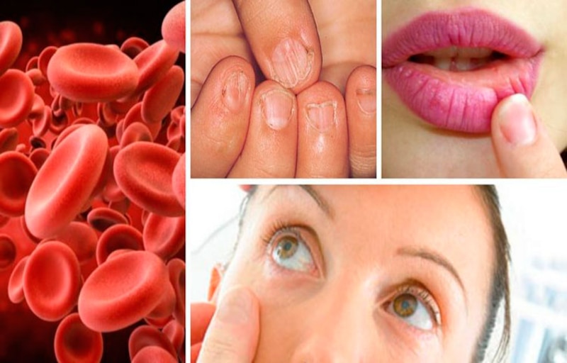 Síntomas de anemia