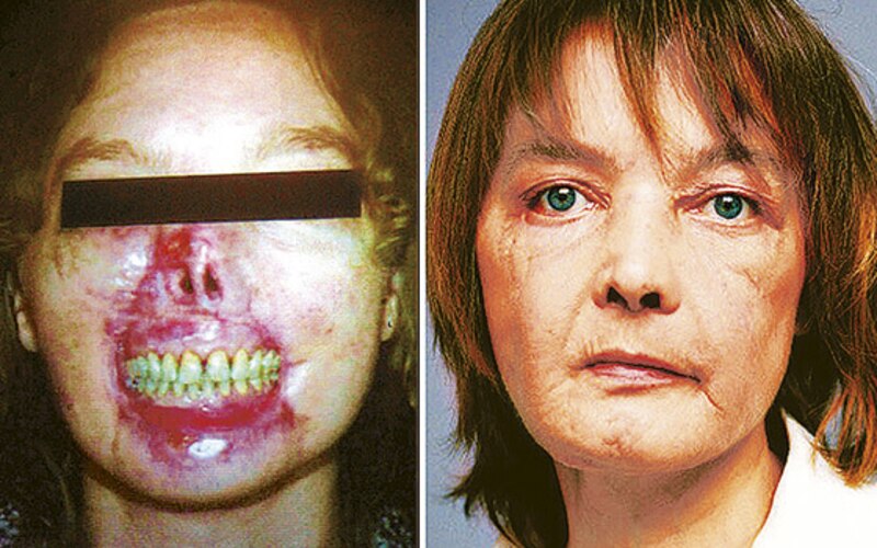 Mujer con cáncer de piel