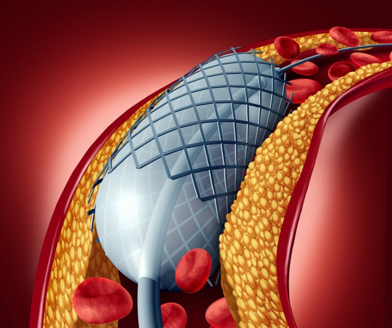 Stent coronario