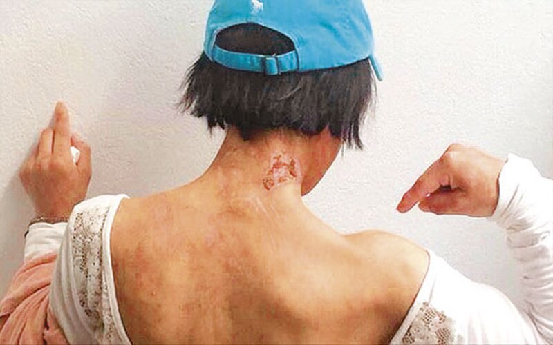 Mujer muestra quemaduras en la espalda tras usar crema para aclarar la piel