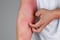 Dermatitis Atópica, hasta un año para ser diagnosticada 
