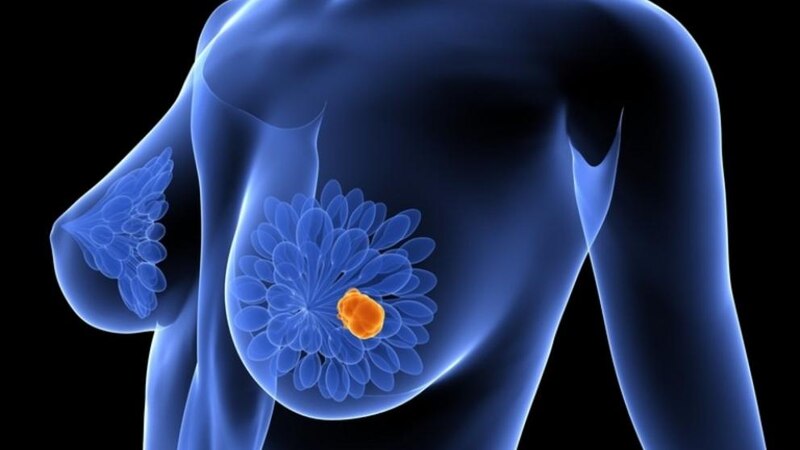 Cáncer de mama