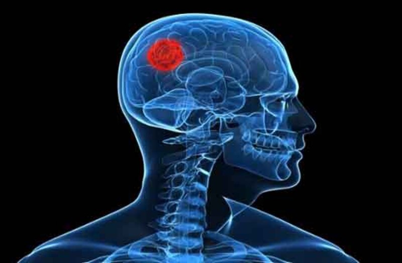 Tumor cerebral