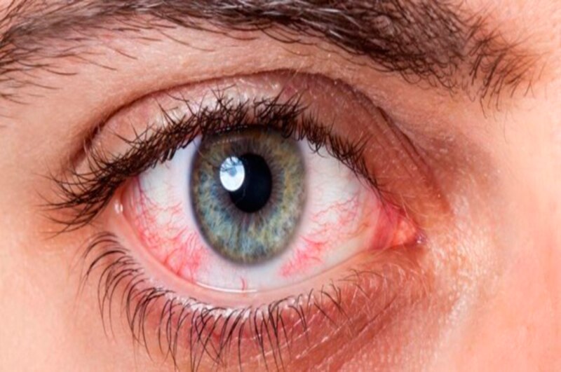 Ojo rojo