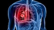 ENTREVISTA | El futuro del cáncer de pulmón: avances y esperanza